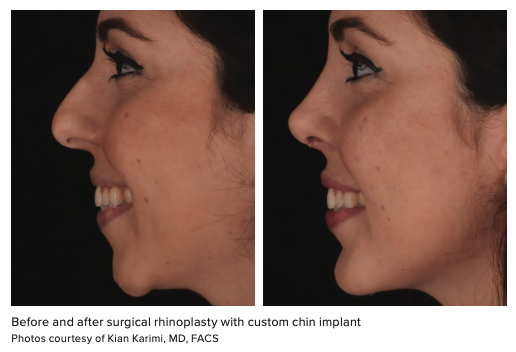 Ethnic Rhinoplasty Before and After Gallery — Kassir Plastic Surgery in NY  and NJ