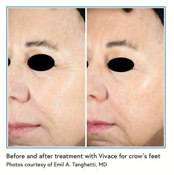 Before and after treatment with Vivace for crow’s feet Photos courtesy of Emil A. Tanghetti, MD
