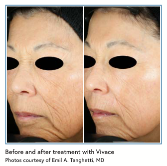 Before and after treatment with Vivace Photos courtesy of Emil A. Tanghetti, MD