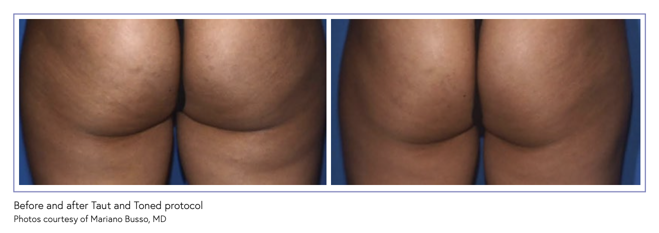 THERAPEUTIX CELLULITE SMOOTHING SHORT