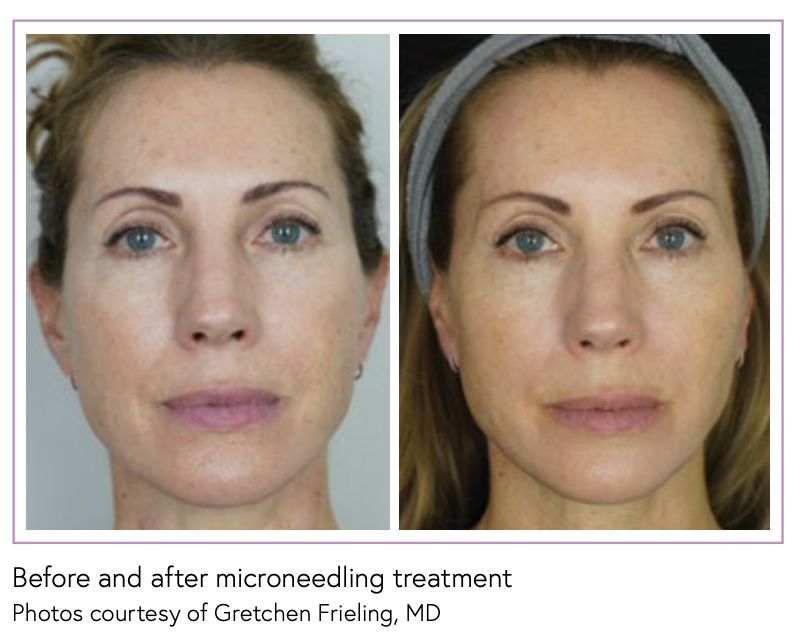 What is Md Pen Microneedling? : Heights Aesthetic Laser Center: Aesthetics